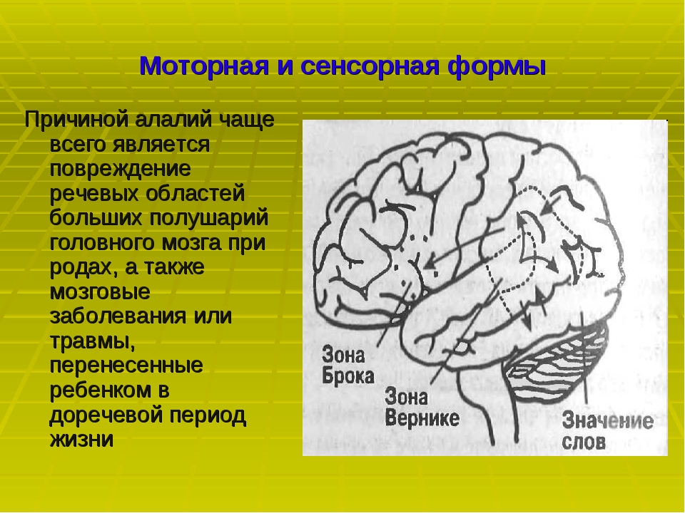 Сенсорно речевые нарушения. Речевые зоны коры головного мозга Брока. Алалия Вернике Брока. Моторные и сенсорные области головного мозга. Моторная алалия локализация поражения.