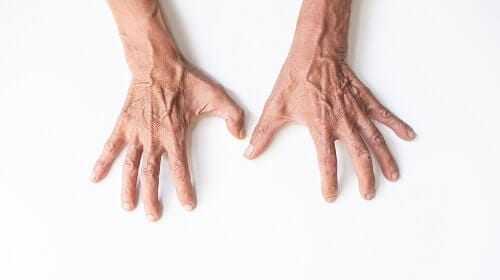 Спазм пальцев рук
