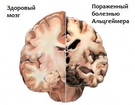Изменения мозга при болезни Альцгеймера